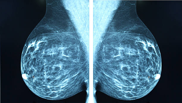 マモグラフィーレイディオ imagingr 乳がんの診断 - medical scan 写真 ストックフォトと画像