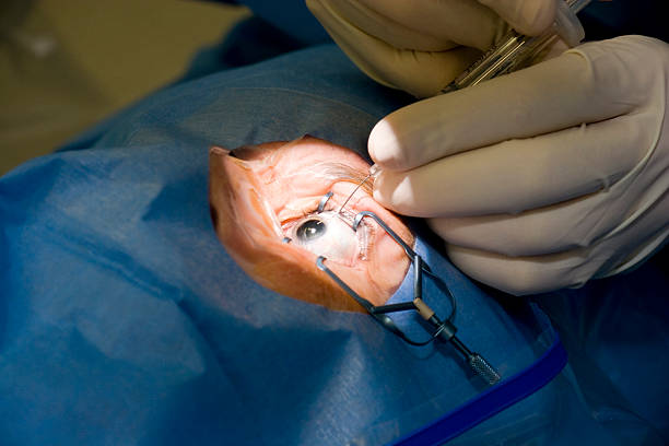 Close-up of surgeons hands performing manual eye surgery stock photo