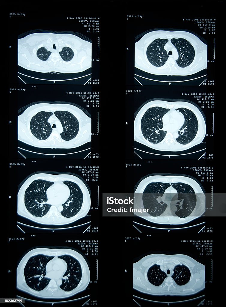 Solitary 폐 결절 - 로열티 프리 X-레이 스톡 사진
