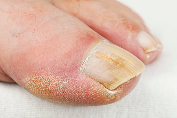 足の爪菌 - fungus toenail human foot onychomycosis ストックフォトと画像