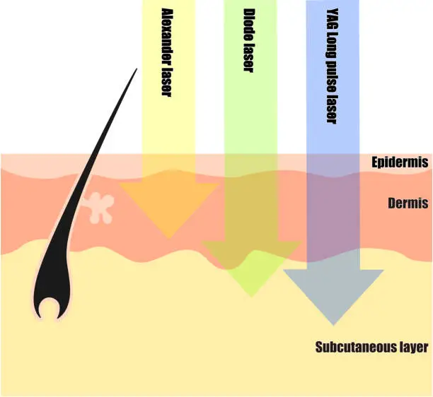 Vector illustration of Differences in hair removal lasers seen in cross-sectional views of the skin