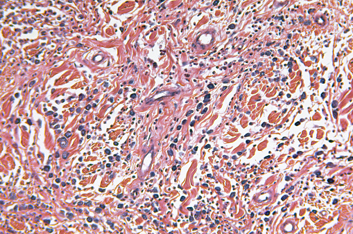 Stomach cancer: Adenocarcinoma of stomach, Microscopic view.