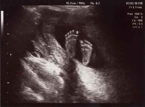 Ultrasound at 18 weeks