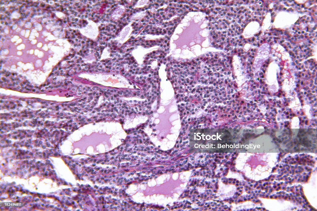 Tiroide ingrossata adenomatosi Iperplasia - Foto stock royalty-free di Tumore tiroideo