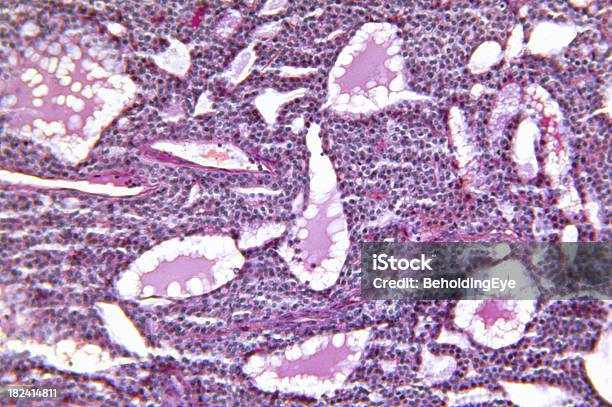 Tiroide Ingrossata Adenomatosi Iperplasia - Fotografie stock e altre immagini di Tumore tiroideo - Tumore tiroideo, Adenoma, Anatomia umana