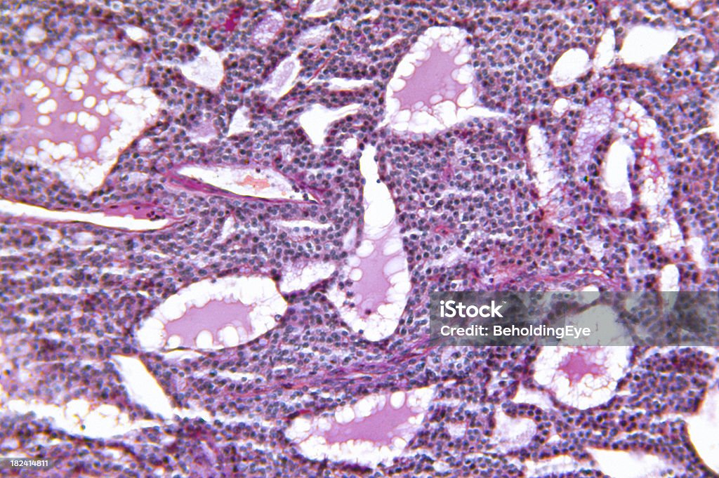 大きな甲状腺 Adenomatous 性過形成 - 甲状腺癌のロイヤリティフリーストックフォト