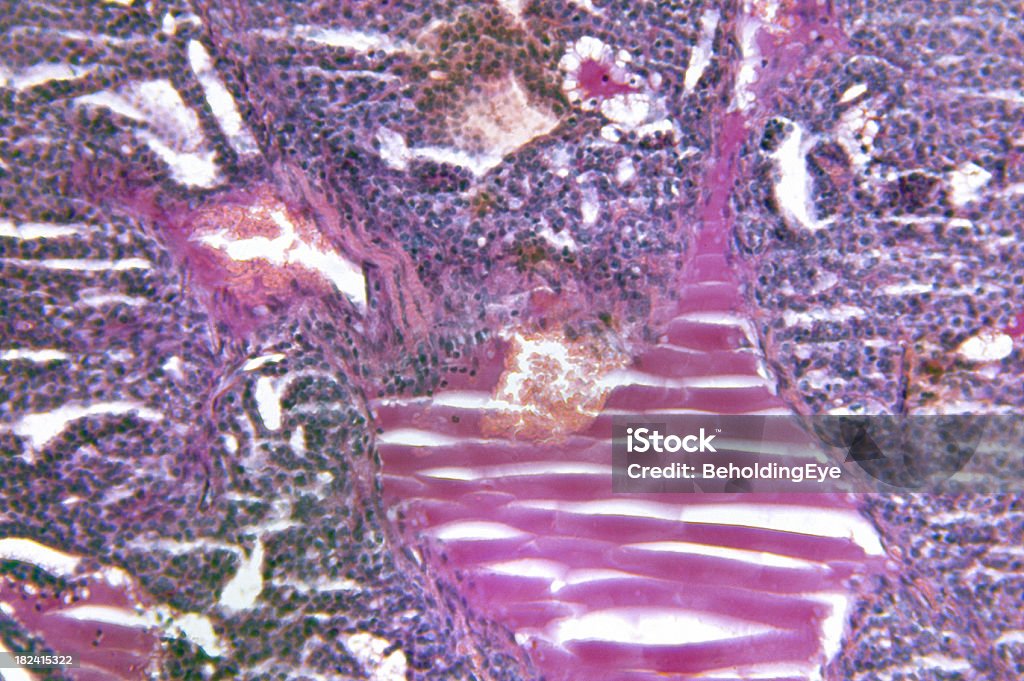 大きな甲状腺 Adenomatous 性過形成 - 甲状腺癌のロイヤリティフリーストックフォト