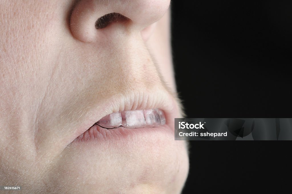 Beißen dental auf Vorschussbasis - Lizenzfrei Zahnschiene Stock-Foto
