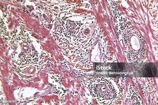 Cysticercus Parasite Encysted In Schwein Muskel Stockfoto und mehr Bilder von Zystizerken - Zystizerken, Abstrakt, Anatomie