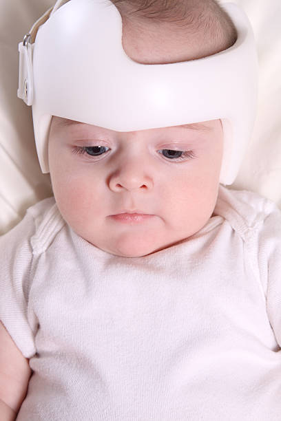 Infant Cranial Orthodic Infant wearing a helmet or band for treatment of plagiocephaly (misshapen head)SEE ALSO: plagiocephaly stock pictures, royalty-free photos & images