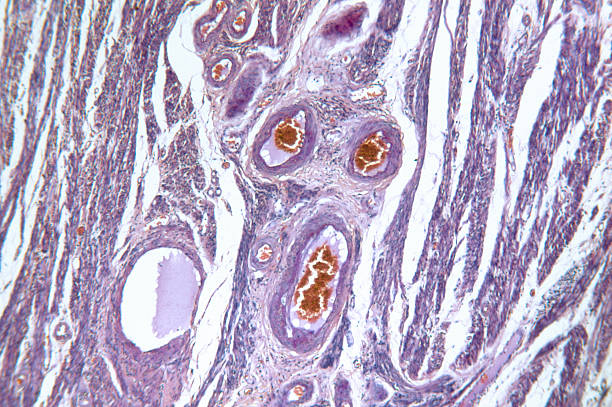 istock Endometrial Adenocarcinoma of Womb 182428413