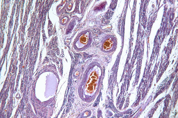 adenocarcinoma de womb hipófise - endometrial adenocarcinoma - fotografias e filmes do acervo