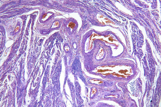 istock Endometrial Adenocarcinoma of Womb 182428416