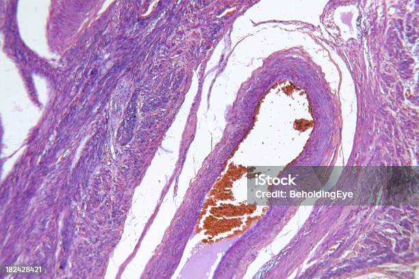 자궁내막암 선암종 입구이고 DNA에 대한 스톡 사진 및 기타 이미지 - DNA, 건강관리와 의술, 과학