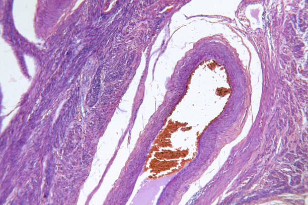 adenocarcinoma de womb hipófise - endometrial adenocarcinoma - fotografias e filmes do acervo