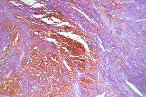 adenocarcinoma de womb hipófise - endometrial adenocarcinoma - fotografias e filmes do acervo