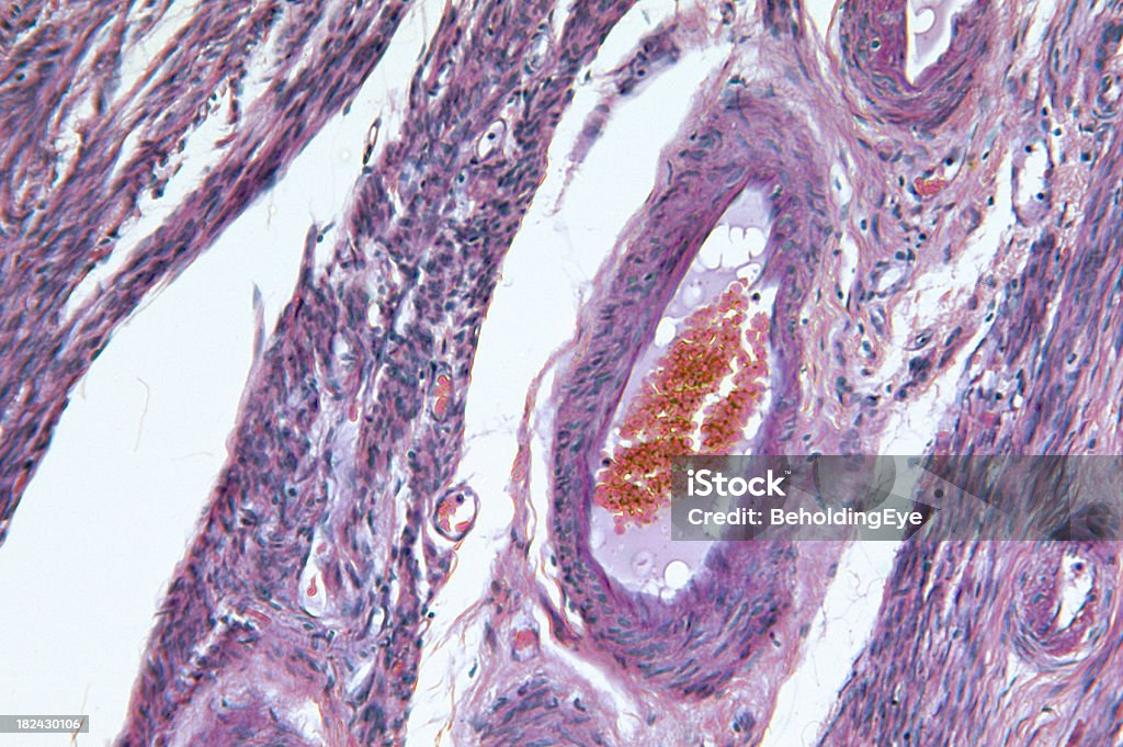Endometrial gruczolakorak macicy. - Zbiór zdjęć royalty-free (Komórka rakowa)