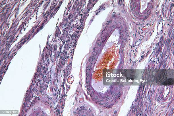 Endometrial Gruczolakorak Macicy - zdjęcia stockowe i więcej obrazów Komórka rakowa - Komórka rakowa, Endometrium, Rak - Nowotwór