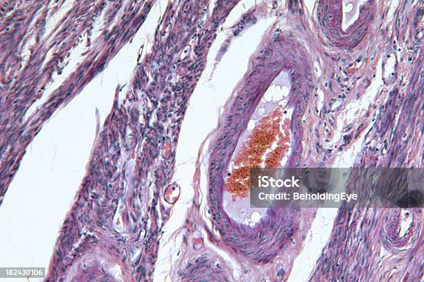 Foto de Adenocarcinoma De Womb Hipófise e mais fotos de stock de Célula Cancerígena - Célula Cancerígena, Câncer - Tumor, Endométrio