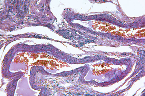 Endometrial adenocarcinoma of womb Microscopic photo of a professionally prepared slide demonstrating the cellular structure of the object. adenocarcinoma photos stock pictures, royalty-free photos & images