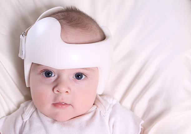 Attrezzatura per Plagiocephaly Orthodic - foto stock