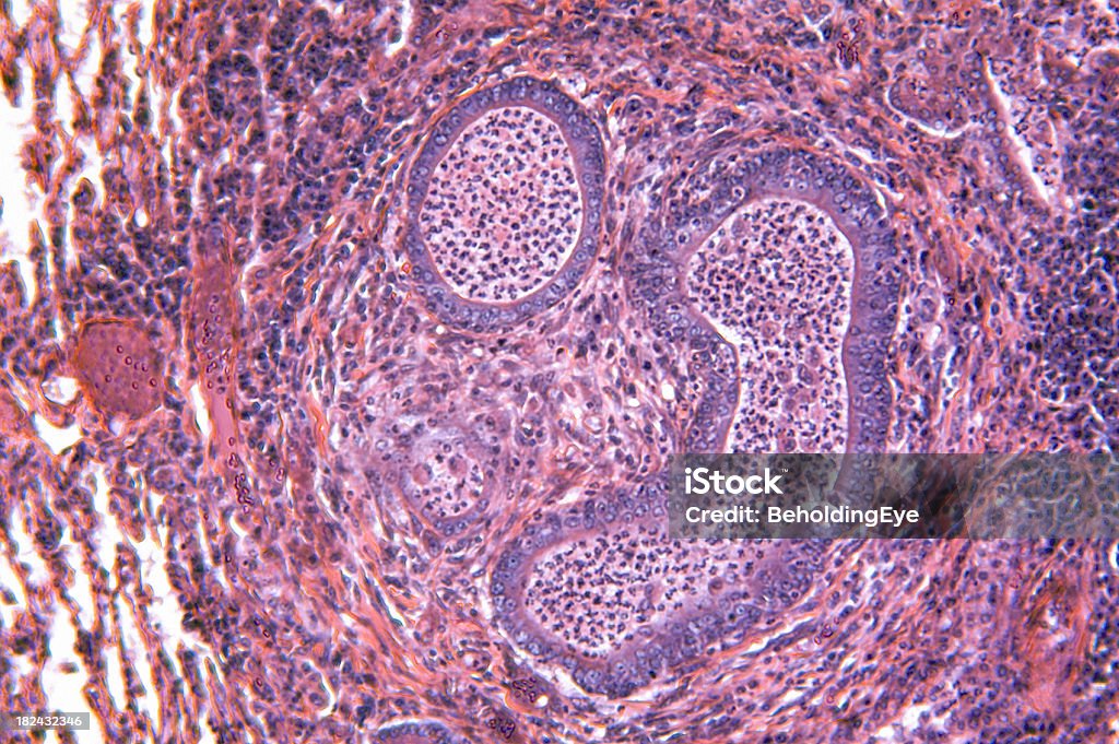 Absceso pulmonar - Foto de stock de ADN libre de derechos