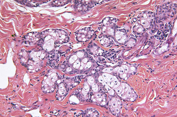 istock Close up of squamous epithelial cell metastatic carcinoma 182435528