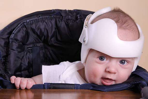 Cranial Orthodic for Plagiocephaly Infant wearing a helmet or band for treatment of plagiocephaly (misshapen head)SEE ALSO: plagiocephaly stock pictures, royalty-free photos & images