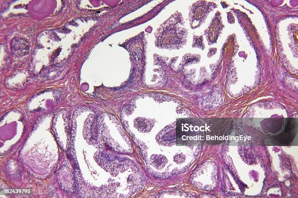 前立腺腺癌 - 前立腺のストックフォトや画像を多数ご用意 - 前立腺, マクロ撮影, 前立腺癌