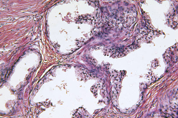 istock Prostate Gland Adenocarcinoma 182440031