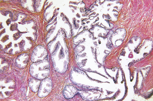 istock Prostate Gland Adenocarcinoma 182440354