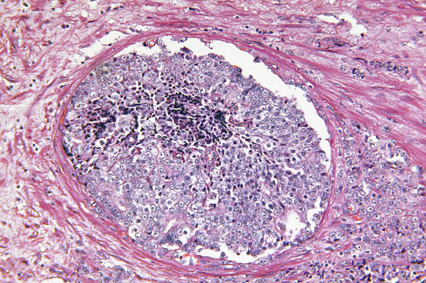 Prostate Gland Adenocarcinoma "Microscopic photo of a professionally prepared slide demonstrating the cellular structure of the object.NOTE: Shallow DOF, uneven focus and chromatic aberration are inherent in microscopy, and what appears as dust is actually in the sample.NON-EXPERT CAVEAT: The composition might be misdirected, showing only healthy tissue.See all my" adenocarcinoma photos stock pictures, royalty-free photos & images