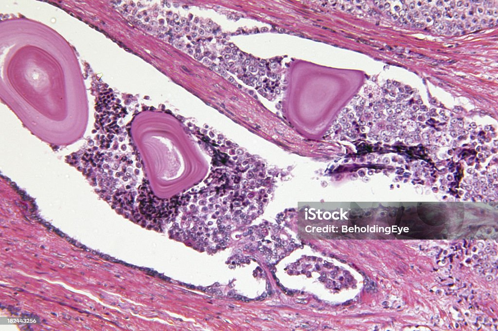 前立腺腺癌 - 前立腺癌のロイヤリティフリーストックフォト