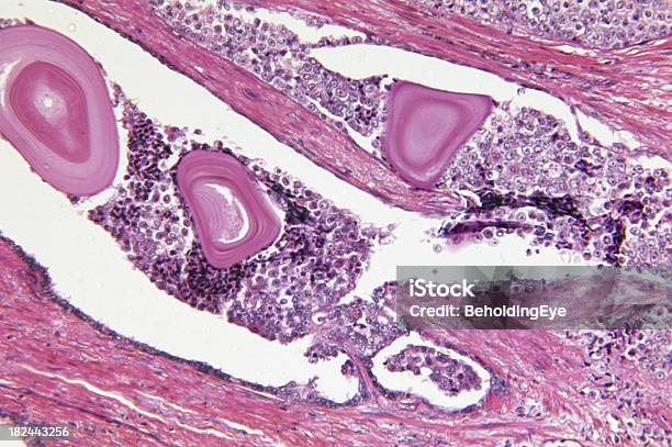 Prostate Gland Adenocarcinoma Stock Photo - Download Image Now - Prostate Cancer, Abstract, Adenocarcinoma