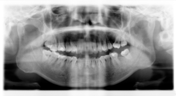 X-Ray of Adult's Teeth & Gums (After 2 years' Straigthen Teeth Period)