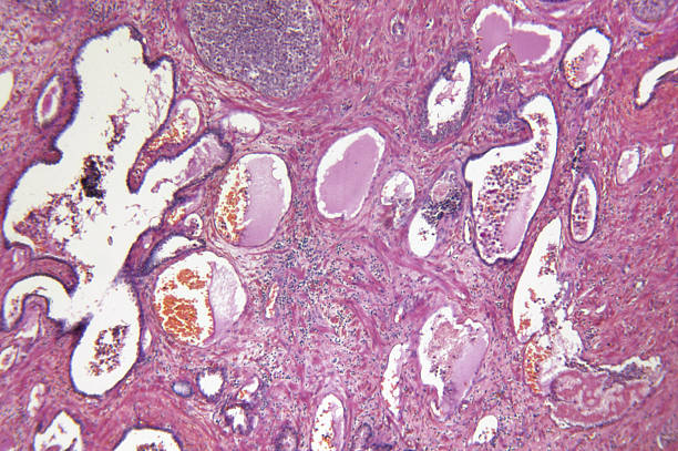 prostate adénocarcinome - prostate gland photos et images de collection