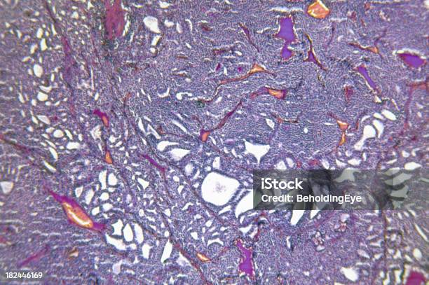 Tiroide Ingrossata Adenomatosi Iperplasia - Fotografie stock e altre immagini di Tumore tiroideo - Tumore tiroideo, Cellula umana, Adenoma