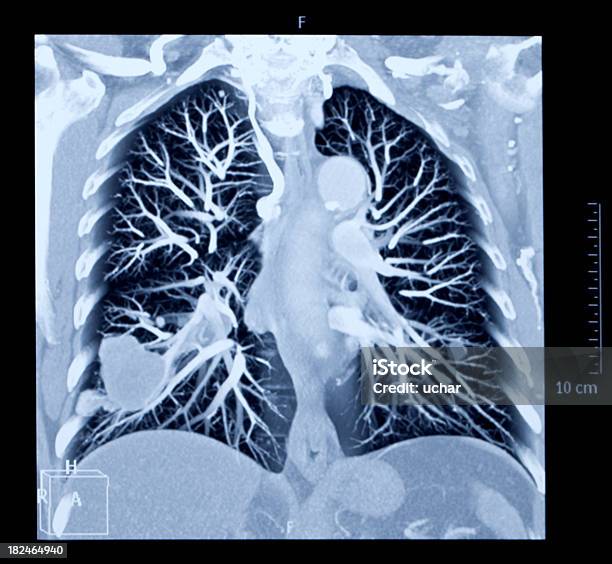 Лёгкое Человека Рентгеновских Изображение — стоковые фотографии и другие картинки Бронхиальное дерево - Бронхиальное дерево, Внутренний орган человека, Горизонтальный