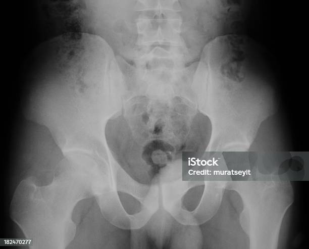 Männliche Becken Xray Von Einem Trauma Stockfoto und mehr Bilder von Knochenbruch - Knochenbruch, Leistenregion, Röntgenbild