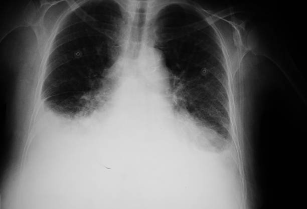 X-ray of a lung that have pulmonary edema  XXL stock photo