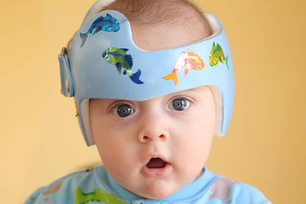 Plagiocephaly trattamento - foto stock