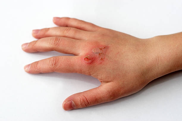 Hand with a third degree burn after fire damage stock photo