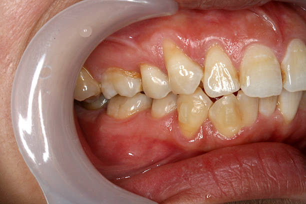 istock Straighten Teeth after 12 month / 1 Year (Right Side View) 182491309