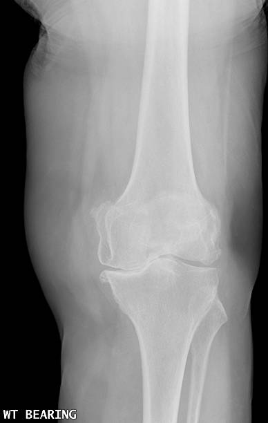 デジタルフルニー xray を示す重大な変形性関節症 ストックフォト