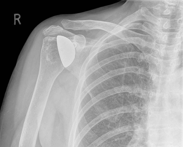 디지탈 x-레이 표시중 어깨 관절 치환술 스톡 사진