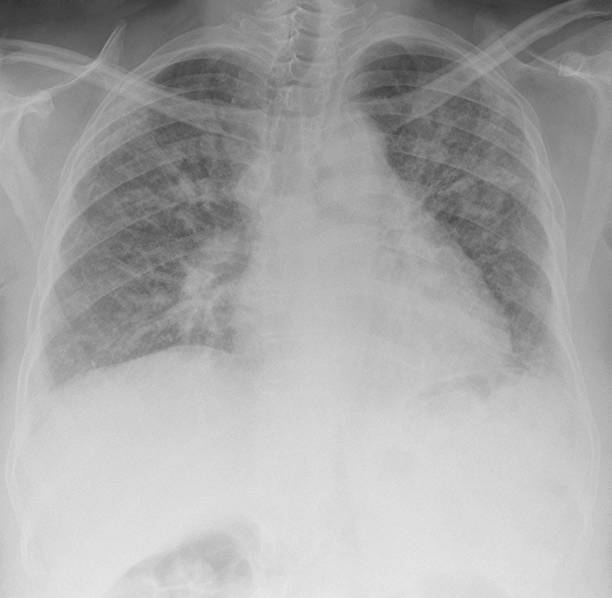 디지탈 흉부 방사선사진이 중증 폐섬유증 스톡 사진