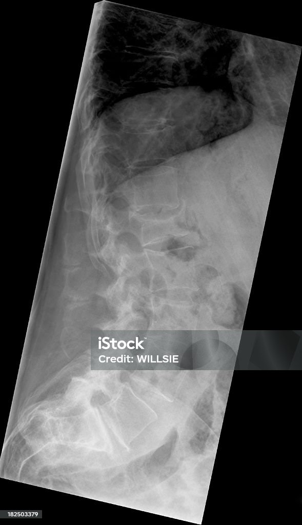 digital de la colonne lombaire x-ray d'ostéoporose de fracture vertébrale - Photo de Fracture libre de droits