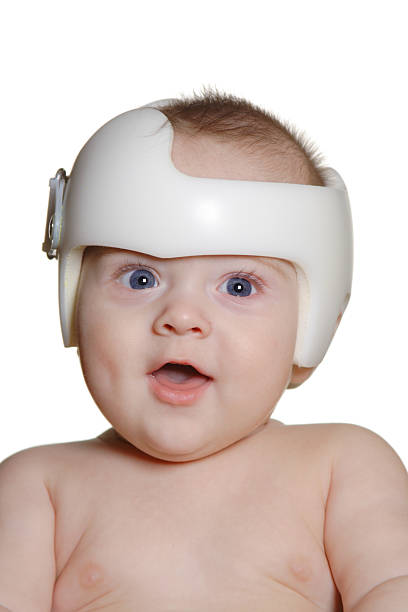 Child wearing band for Plagiocephaly Infant wearing a helmet or band for treatment of plagiocephaly SEE ALSO: plagiocephaly stock pictures, royalty-free photos & images