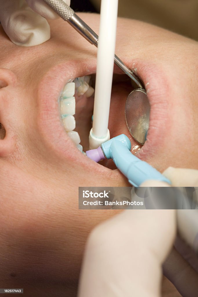 Dentist Cleaning and Polishing Teeth with a Rotary Dental Tool  Angled Mirror Stock Photo