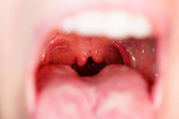 istock Cleft, bifurcation of the uvula. malformations. 1826172807